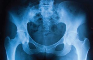 X-Ray of the Hips